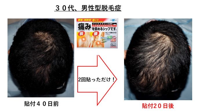 円形脱毛症　病院